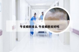 牛皮癣脱皮么 牛皮癣脱皮好吗