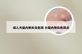 成人大腿内侧长白色斑 大腿内侧白色斑点