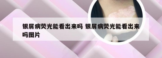 银屑病荧光能看出来吗 银屑病荧光能看出来吗图片