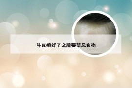 牛皮癣好了之后要禁忌食物