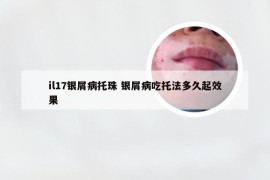 il17银屑病托珠 银屑病吃托法多久起效果