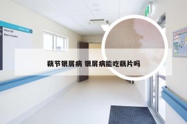 藕节银屑病 银屑病能吃藕片吗