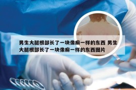 男生大腿根部长了一块像癣一样的东西 男生大腿根部长了一块像癣一样的东西图片