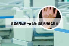 银屑病可以用什么洗脸 银屑病用什么擦脸