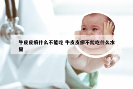 牛皮皮癣什么不能吃 牛皮皮癣不能吃什么水果