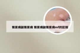 银屑病副银屑病 银屑病副银屑病mf的区别