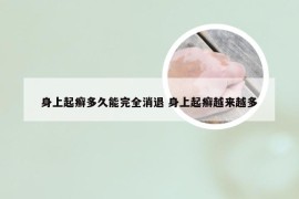 身上起癣多久能完全消退 身上起癣越来越多