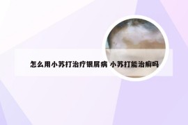 怎么用小苏打治疗银屑病 小苏打能治癣吗