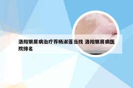 洛阳银屑病治疗荐杨淑莲当找 洛阳银屑病医院排名