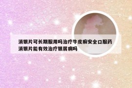 消银片可长期服用吗治疗牛皮癣安全口服药 消银片能有效治疗银屑病吗
