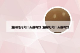 治藓的药膏什么最有效 治癣乳膏什么最有效