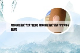 银屑病治疗较好医院 银屑病治疗最好的专科医院