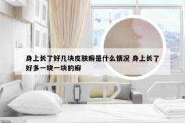 身上长了好几块皮肤癣是什么情况 身上长了好多一块一块的癣