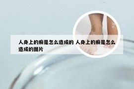 人身上的癣是怎么造成的 人身上的癣是怎么造成的图片
