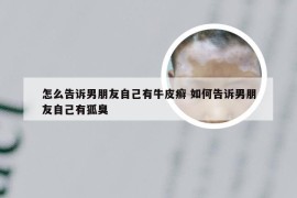 怎么告诉男朋友自己有牛皮癣 如何告诉男朋友自己有狐臭