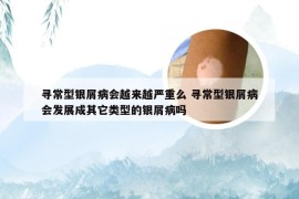 寻常型银屑病会越来越严重么 寻常型银屑病会发展成其它类型的银屑病吗
