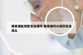 银屑病能用肥皂洗澡吗 银屑病可以用药皂洗澡么