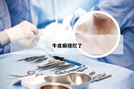 牛皮癣挠烂了
