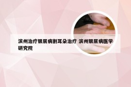 滨州治疗银屑病割耳朵治疗 滨州银屑病医学研究院