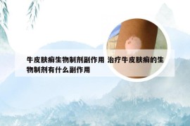 牛皮肤癣生物制剂副作用 治疗牛皮肤癣的生物制剂有什么副作用