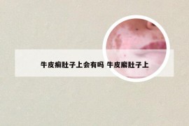 牛皮癣肚子上会有吗 牛皮廨肚子上