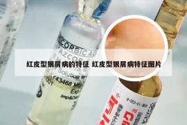 红皮型银屑病的特征 红皮型银屑病特征图片