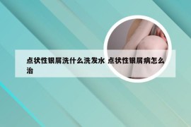 点状性银屑洗什么洗发水 点状性银屑病怎么治