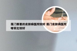 厦门那里的皮肤癣医院较好 厦门皮肤病医院哪家比较好
