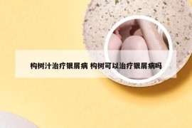 构树汁治疗银屑病 构树可以治疗银屑病吗