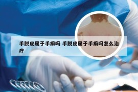 手脱皮属于手癣吗 手脱皮属于手癣吗怎么治疗