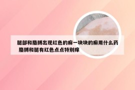 腿部和胳膊出现红色的癣一块块的癣用什么药 胳膊和腿有红色点点特别痒