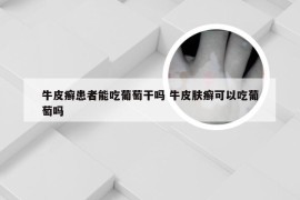 牛皮癣患者能吃葡萄干吗 牛皮肤癣可以吃葡萄吗