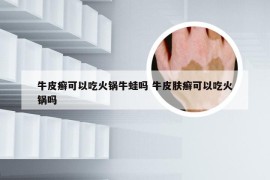 牛皮癣可以吃火锅牛蛙吗 牛皮肤癣可以吃火锅吗