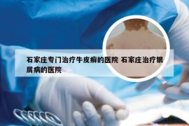石家庄专门治疗牛皮癣的医院 石家庄治疗银屑病的医院