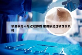 银屑病是不是过敏体质 银屑病是过敏性皮炎吗