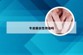 牛皮癣会性传染吗