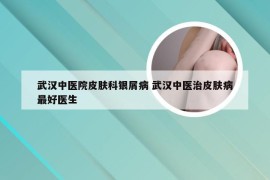 武汉中医院皮肤科银屑病 武汉中医治皮肤病最好医生