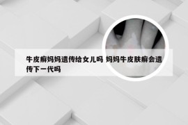 牛皮癣妈妈遗传给女儿吗 妈妈牛皮肤癣会遗传下一代吗