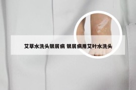 艾草水洗头银屑病 银屑病用艾叶水洗头