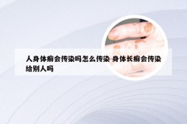人身体癣会传染吗怎么传染 身体长癣会传染给别人吗
