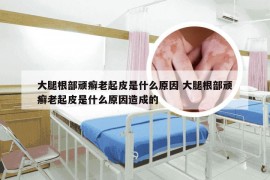大腿根部顽癣老起皮是什么原因 大腿根部顽癣老起皮是什么原因造成的