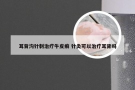 耳背沟针刺治疗牛皮癣 针灸可以治疗耳背吗