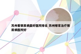 苏州看银屑病最好医院排名 苏州哪家治疗银屑病医院好