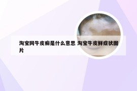 淘宝网牛皮癣是什么意思 淘宝牛皮鲜症状图片