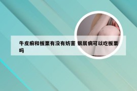 牛皮癣和板栗有没有妨害 银屑病可以吃板栗吗