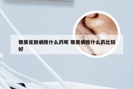 银屑皮肤病擦什么药呢 银屑病擦什么药比较好