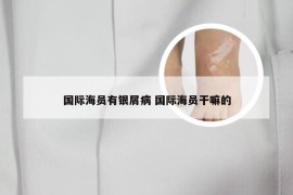 国际海员有银屑病 国际海员干嘛的