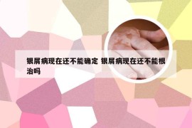 银屑病现在还不能确定 银屑病现在还不能根治吗