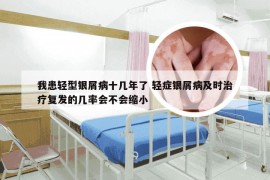 我患轻型银屑病十几年了 轻症银屑病及时治疗复发的几率会不会缩小