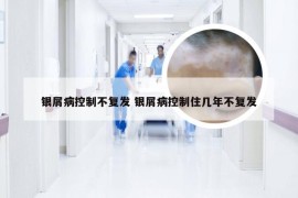 银屑病控制不复发 银屑病控制住几年不复发